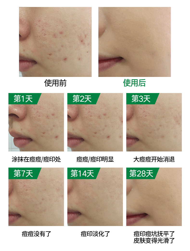 商品Kelo-cote|美国芭克修复疤痕15g,价格¥296,第5张图片详细描述