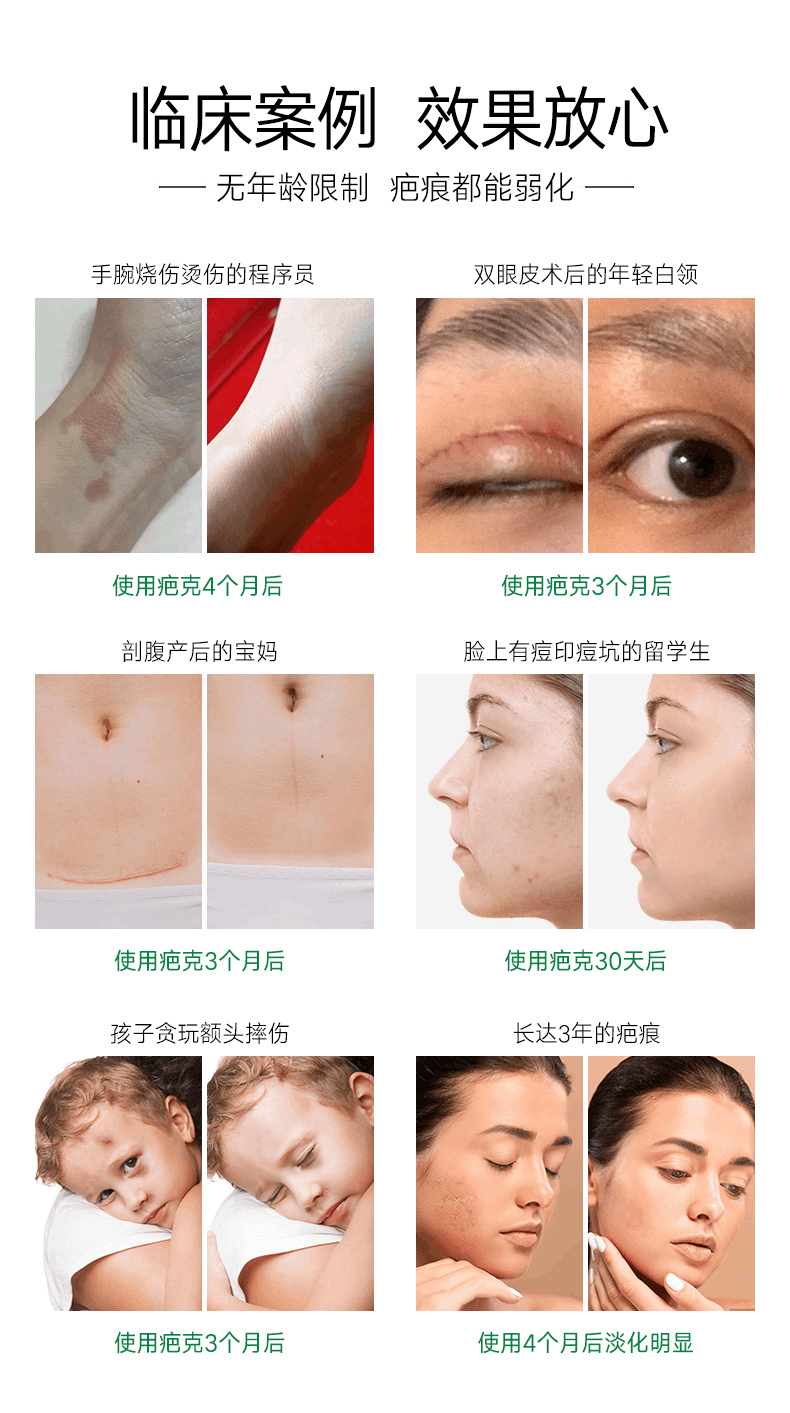 商品Kelo-cote|美国芭克修复疤痕15g,价格¥296,第7张图片详细描述