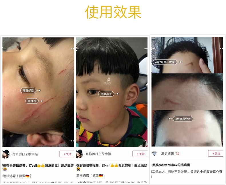 商品Contractubex|德国原版进口Contractubex秀碧袪疤膏修复除疤膏凝胶去疤膏,价格¥170,第19张图片详细描述