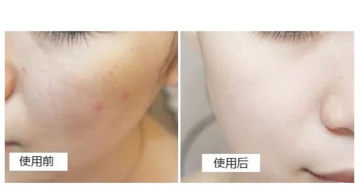 商品La Roche Posay|法国 理肤泉 疤痕舒缓修复霜B5 100ml,价格¥173,第5张图片详细描述