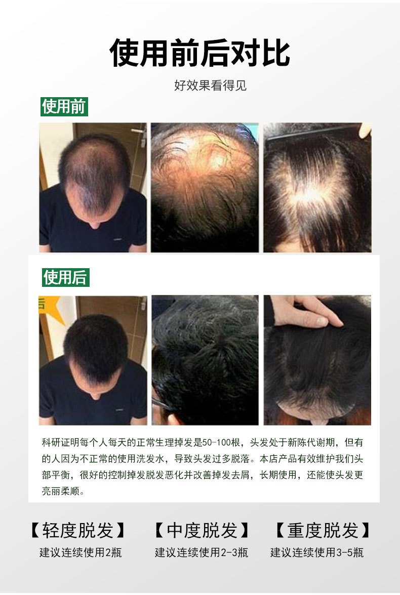商品Hisamitsu|日本长生堂JG生发液治疗脱发症防脱生发�增发密发固发水脱发营养液,价格¥104,第6张图片详细描述