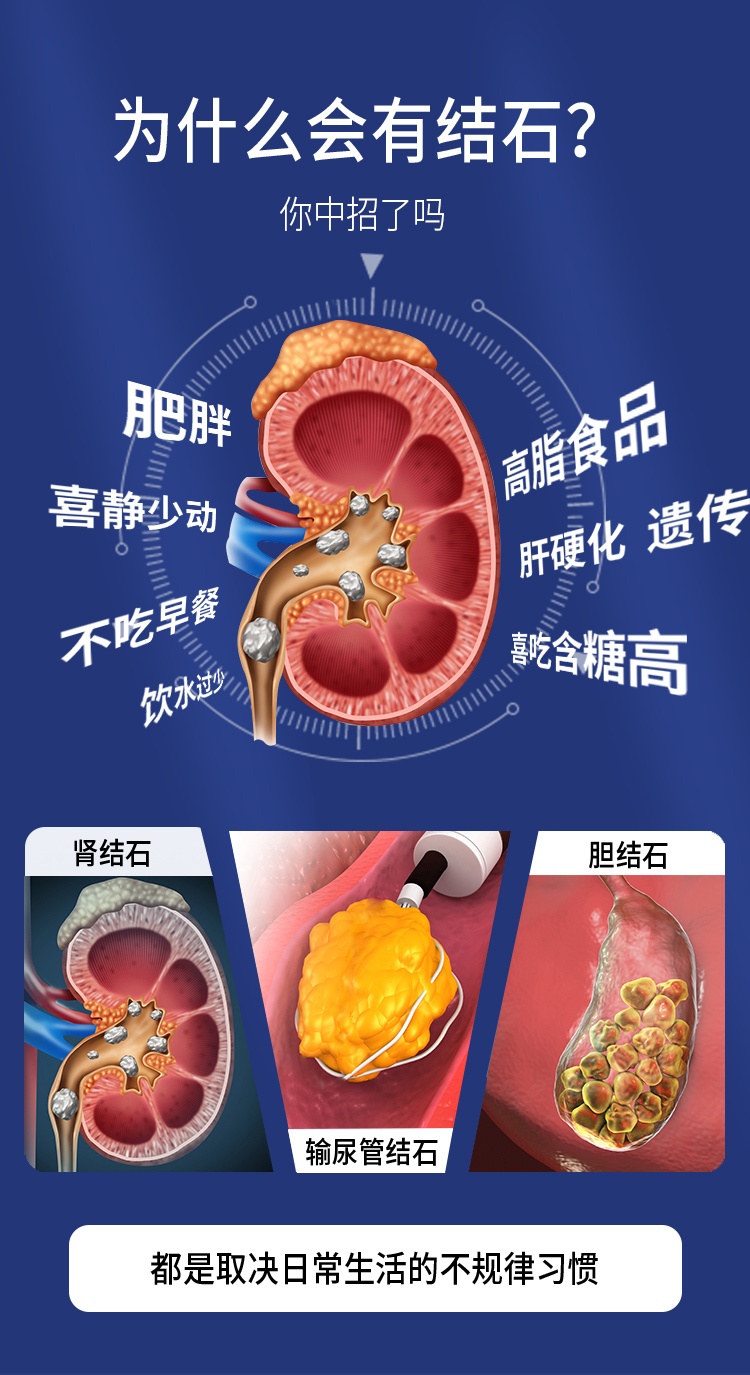 商品Biowell|Biowell 进口强力消石素消肾结石德国排石碎石胆结石利石利尿60粒,价格¥386,第8张图片详细描述