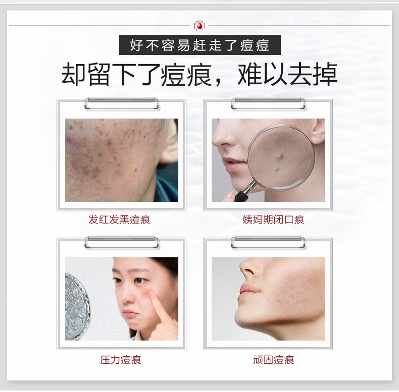 商品Winona|薇诺娜净痘清颜霜50g 淡化痘印痘痘敏感肌肤祛痘舒缓,价格¥222,第3张图片详细描述