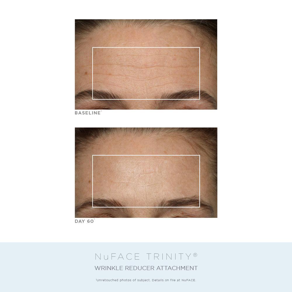 商品NuFace|NuFACE Trinity® Complete Facial Toning Kit ($623 VALUE),价格¥3865,第5张图片详细描述