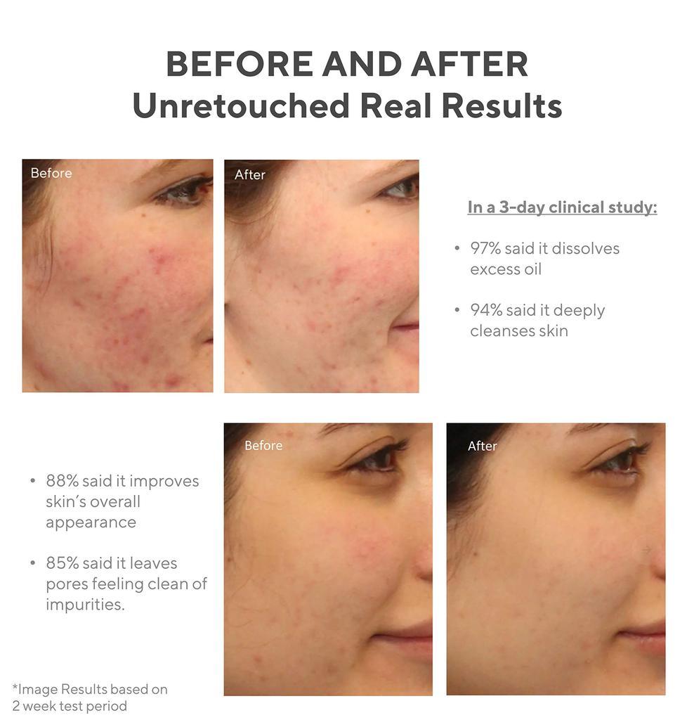商品Murad|Murad Clarifying Facial Cleanser - Acne Control Salicylic Acid & Green Tea Extract Face Wash - Exfoliating Acne Skin Care Treatment Backed by Science,价格¥195-¥352,第6张图片详细描述