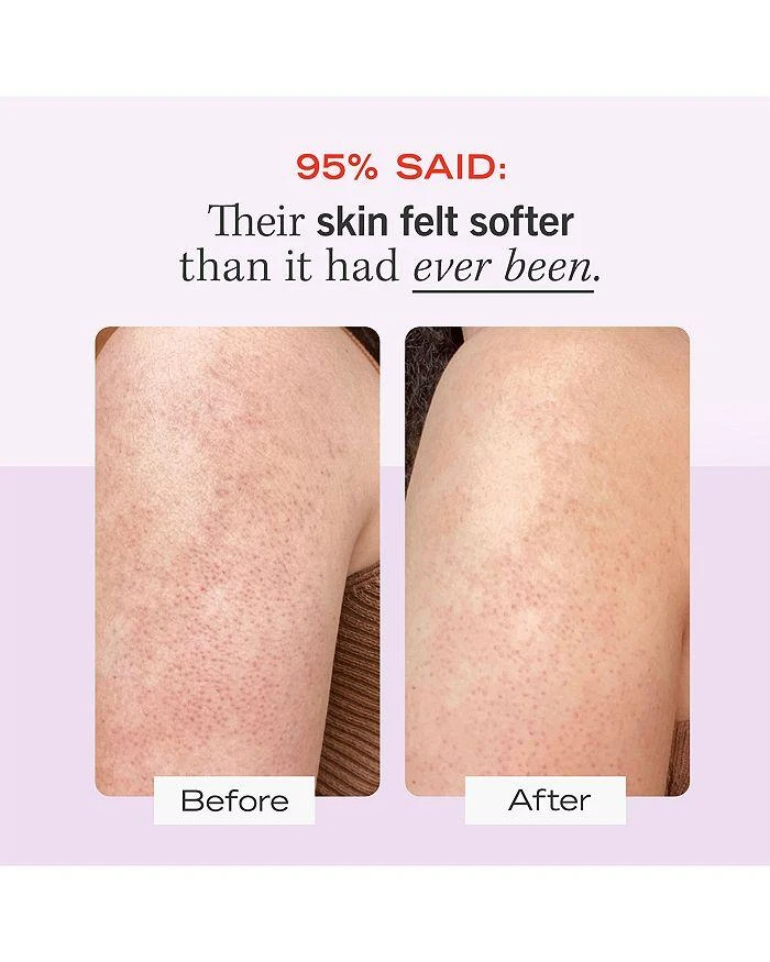 KP Bump Eraser Body Scrub with 10% AHA - Body Exfoliant for Keratosis Pilaris 商品