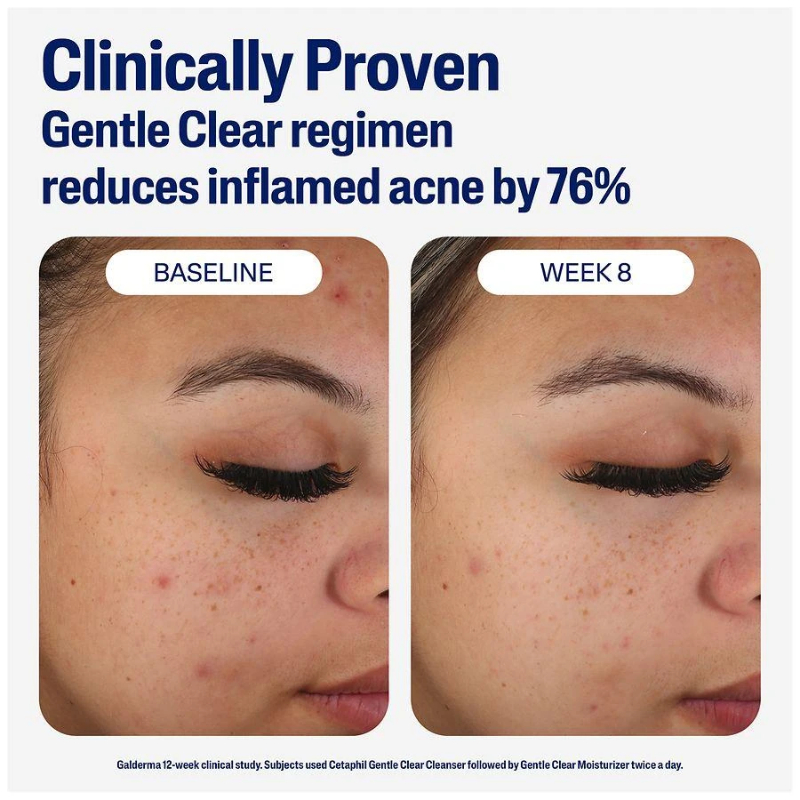 Gentle Clear Mattifying Acne Moisturizer 商品