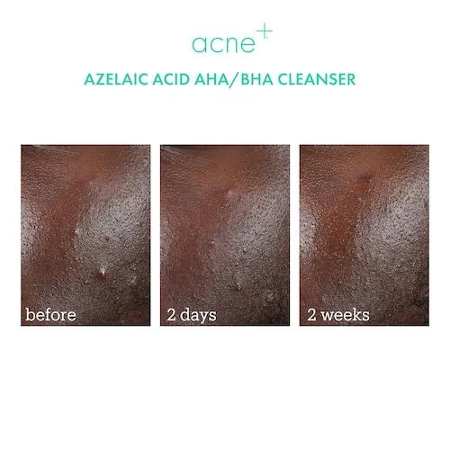 商品Skinfix|Acne+ 2% BHA + Azelaic Acid + Niacinamide + AHA Cleanser,价格¥78,第3张图片详细描述