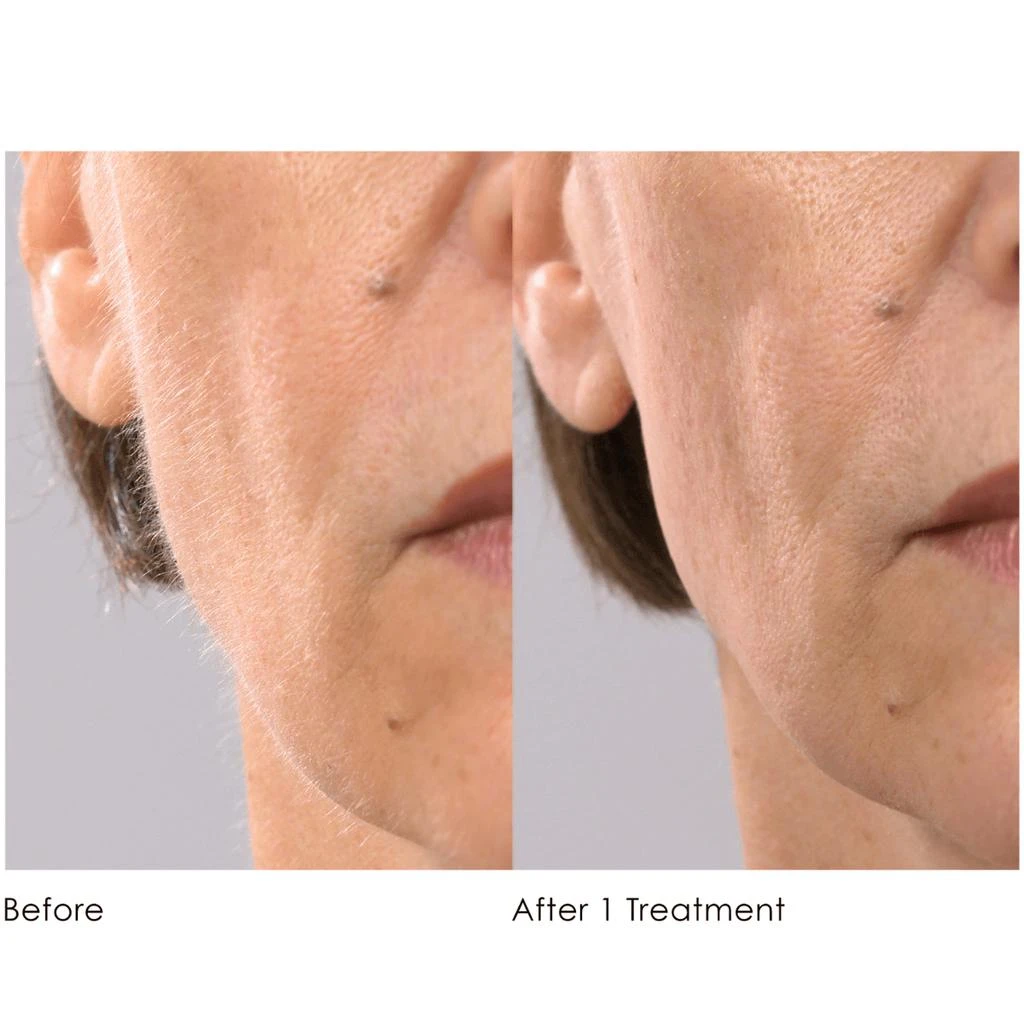 商品Michael Todd Beauty|Michael Todd Beauty Sonicsmooth Hair Removal System,价格¥720,第3张图片详细描述