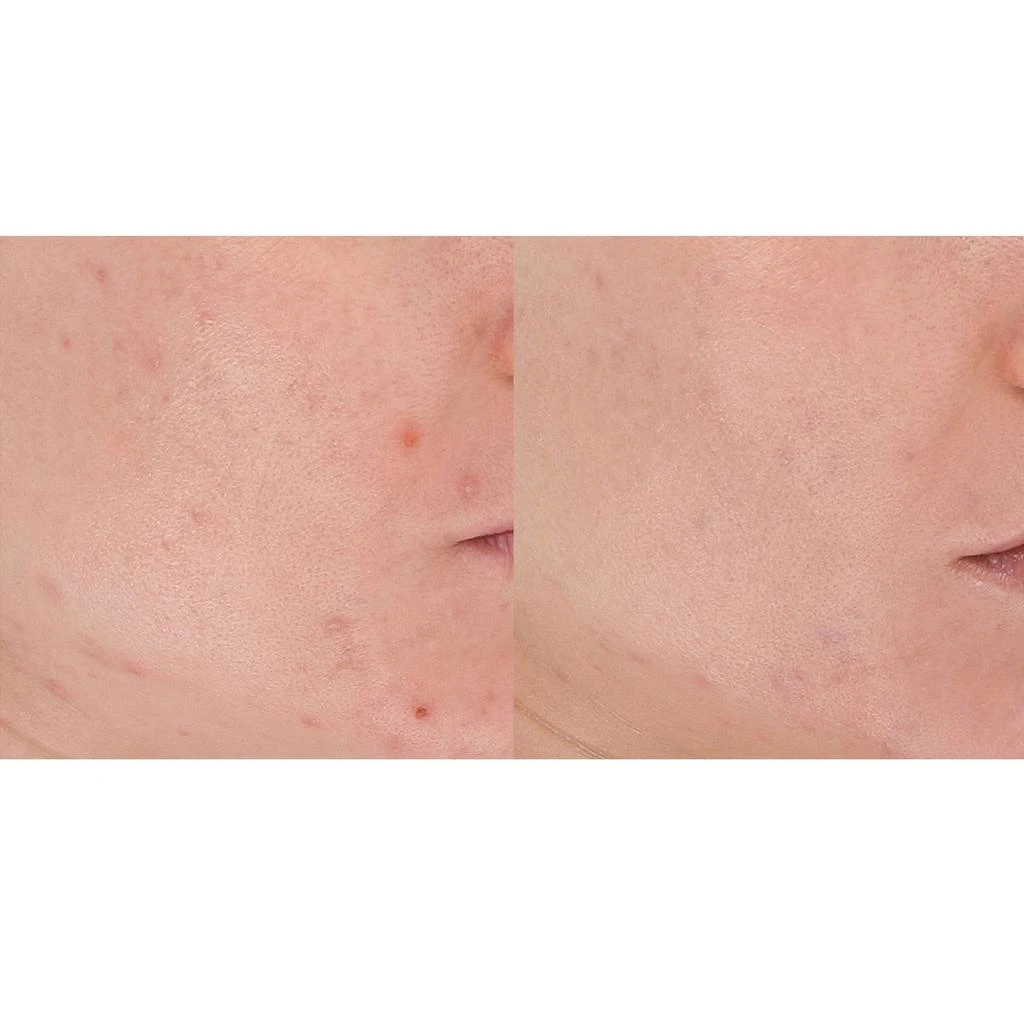 LightStim for Acne 商品