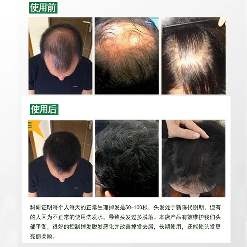 日本长生堂JG生发液治疗脱发症防脱生发增发密发固发水脱发营养液 商品