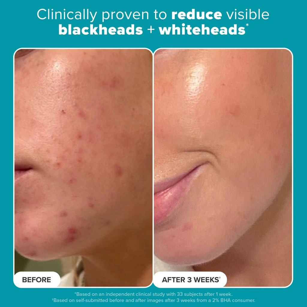 商品Paula's Choice|Paula's Choice SKIN PERFECTING 2 BHA Liquid Exfoliant,价格¥117,第4张图片详细描述