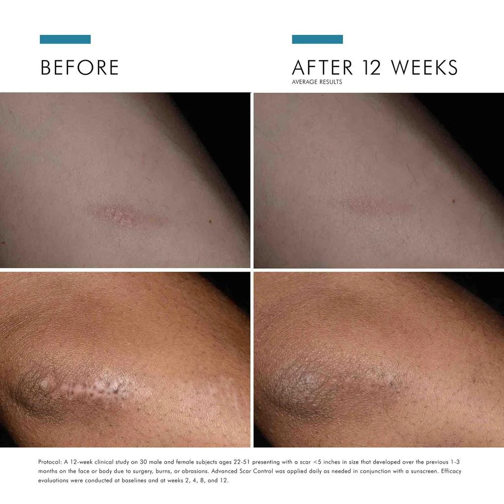 商品SkinCeuticals|SkinCeuticals Advanced Scar Control Skin Protectant Gel,价格¥950,第5张图片详细描述
