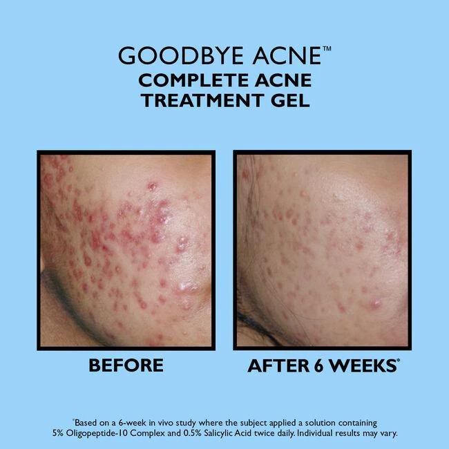 商品Peter Thomas Roth|Full-Size Goodbye Acne Acne Treatment Pair 2-Piece Acne Kit,价格¥358,第1张图片