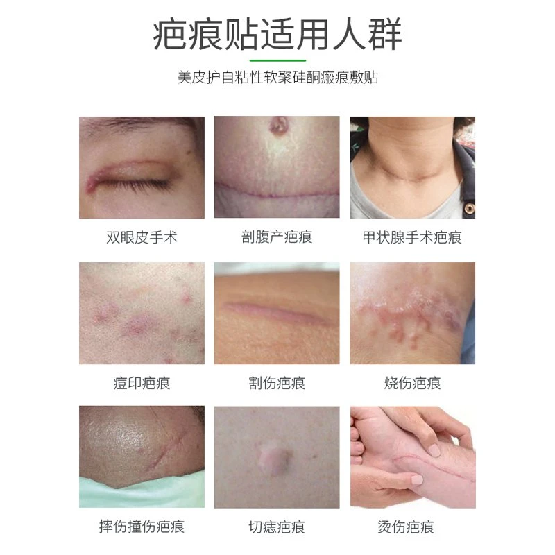 瑞典进口美皮护Mepiform增生硅凝胶祛疤贴5*7.5cm 商品