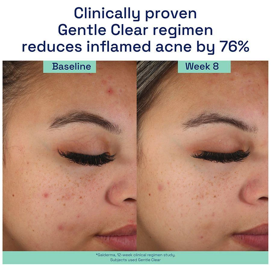 商品Cetaphil|Gentle Clear Mattifying Acne Moisturizer,价格¥83,第2张图片详细描述