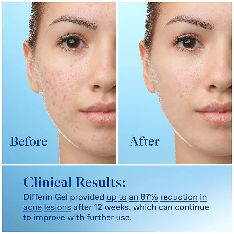 Gel Acne Treatment 商品