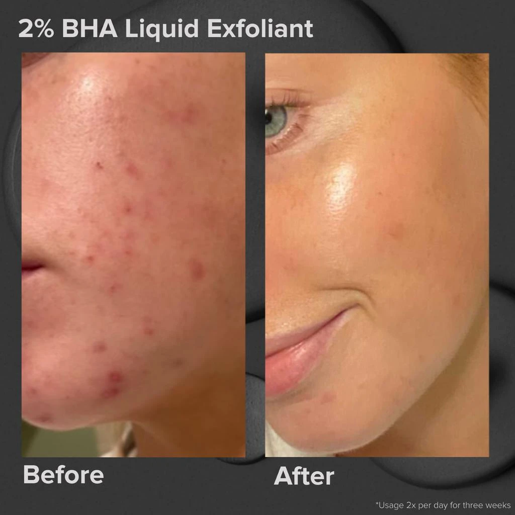 商品Paula's Choice|Skin Perfecting 2% BHA Liquid Exfoliant,价格¥115-¥335,第5张图片详细描述