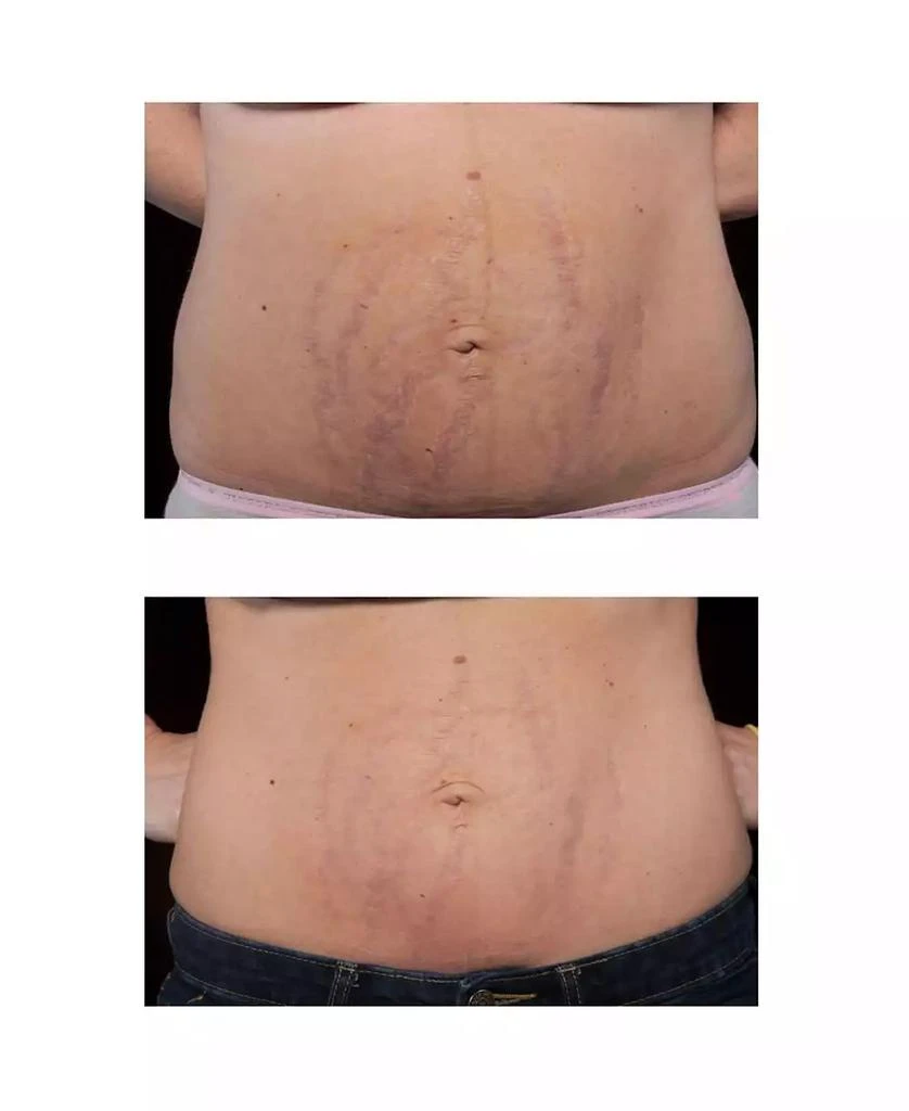 商品STRIALITE|Stretchmark Device,价格¥2609,第5张图片详细描述