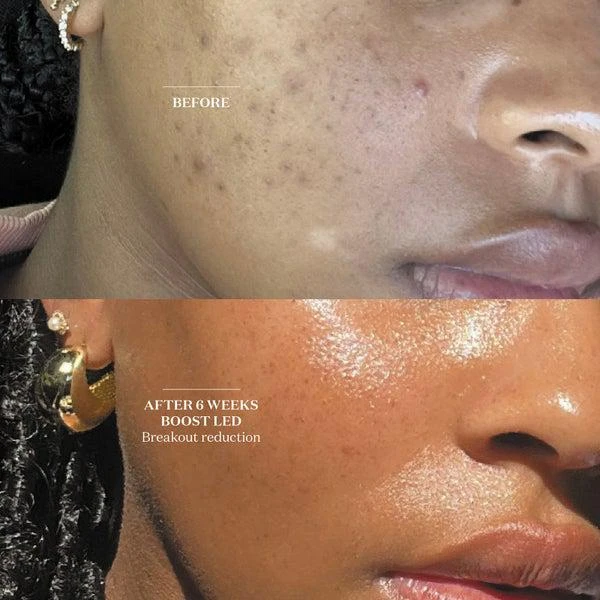 商品The Light Salon|The Light Salon Boost LED Mask,价格¥4013,第3张图片详细描述