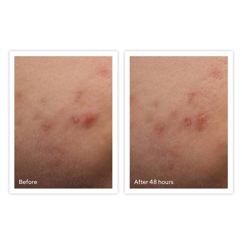 商品Murad|Murad Rapid Relief Acne Spot Treatment,价格¥183,第6张图片详细描述