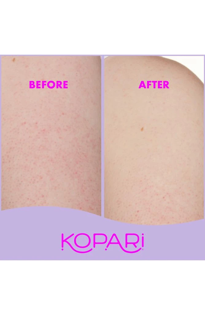 商品Kopari|KP Body Bumps Be Gone with 10% AHA Exfoliator,价格¥211,第3张图片详细描述