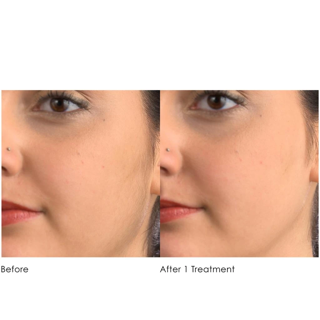 商品Michael Todd Beauty|Michael Todd Beauty Sonicsmooth Hair Removal System,价格¥720,第4张图片详细描述