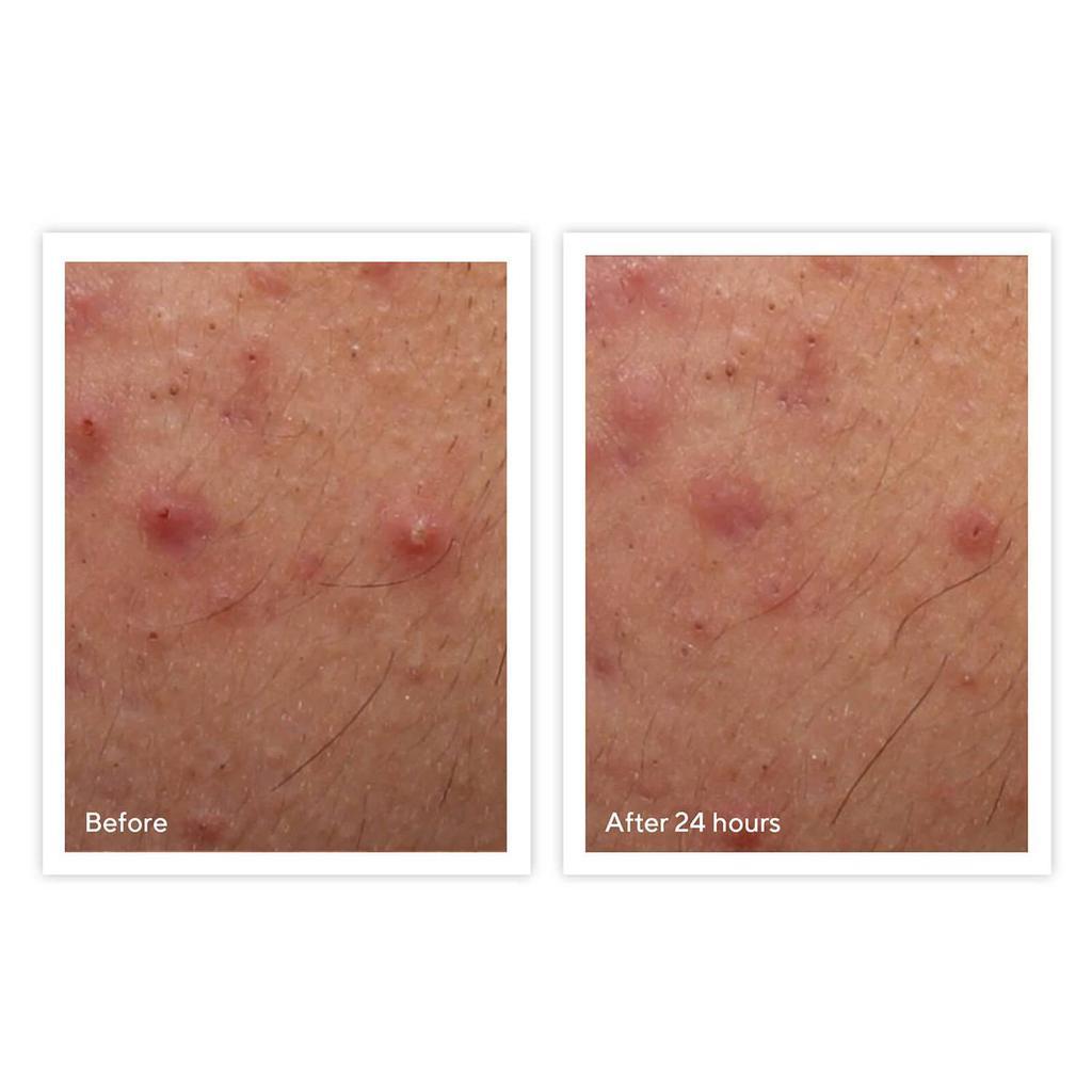 商品Murad|Murad Rapid Relief Acne Spot Treatment,价格¥183,第5张图片详细描述