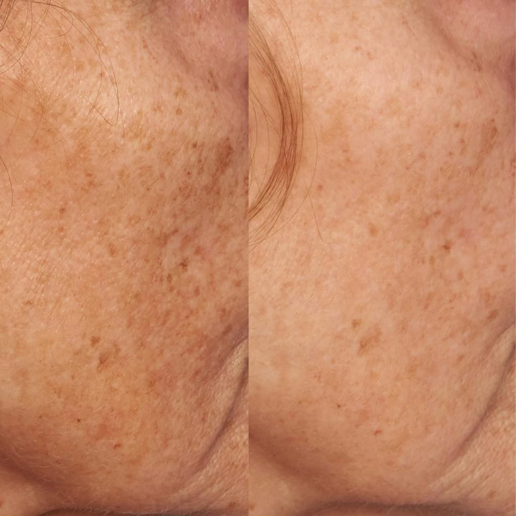 商品Perricone MD|Vitamin C Ester Intensive Dark Spot Treatment,价格¥523,第4张图片详细描述