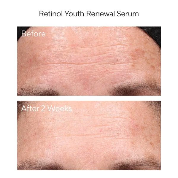 商品Murad|Murad Youth Renewal Retinol Trial Kit (Worth $98.00),价格¥475,第5张图片详细描述