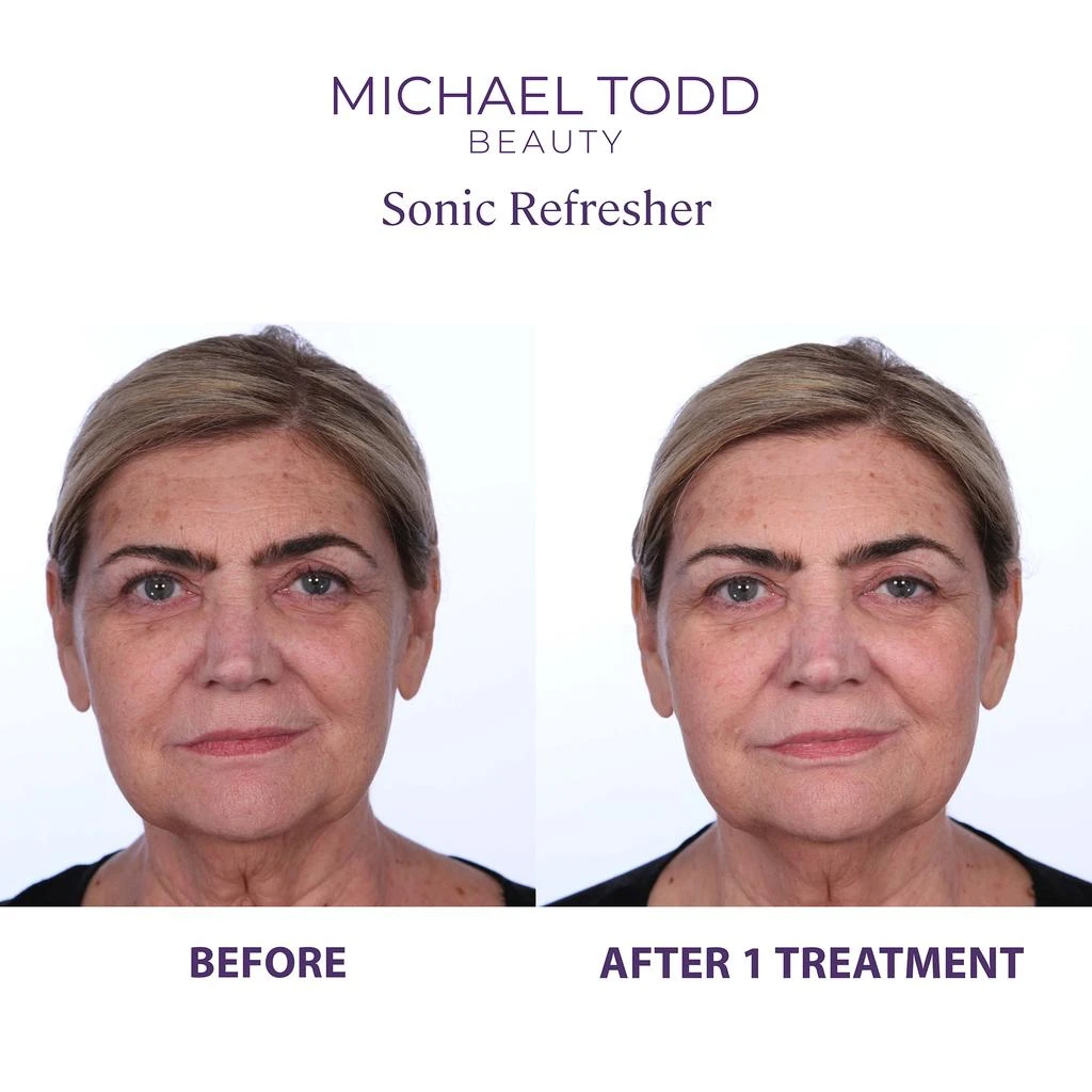 Michael Todd Beauty Sonic Refresher Wet/Dry Sonic Microdermabrasion and Pore Extraction System 商品