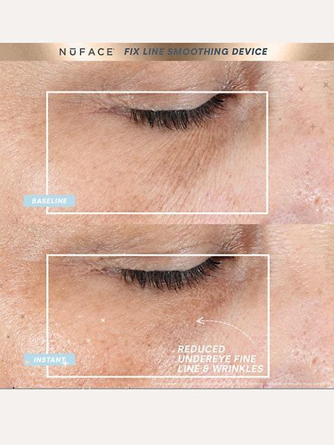 Fix® Line Smoothing Regimen 2-Piece Device & Serum Set商品第3张图片规格展示
