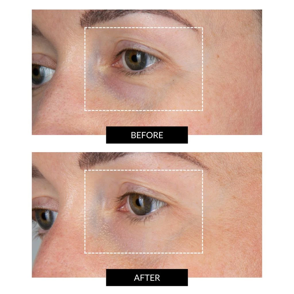 商品CurrentBody Skin|CurrentBody Skin LED Eye Perfector & 5 Eye Hydrogel Masks (worth $284),价格¥1935,第3张图片详细描述