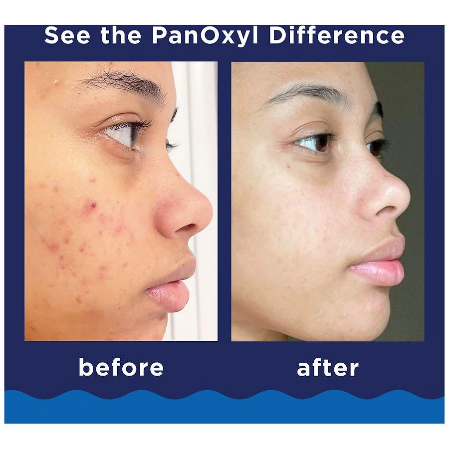 商品PanOxyl|Foaming Acne Wash Maximum Strength 10% Benzoyl Peroxide,价格¥93,第5张图片详细描述