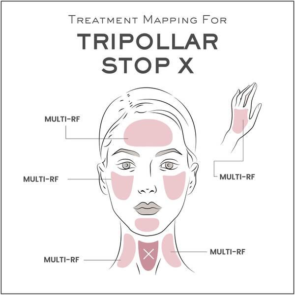 玫瑰金限定版 TriPollar Stop X 射频美容仪(美版需转化器，只有一档）商品第4张图片规格展示