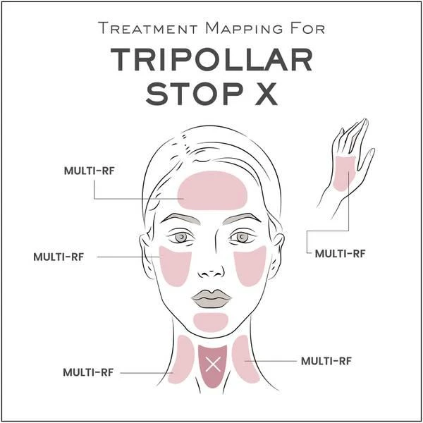 玫瑰金限定版 TriPollar Stop X 射频美容仪(美版需转化器，只有一档） 商品