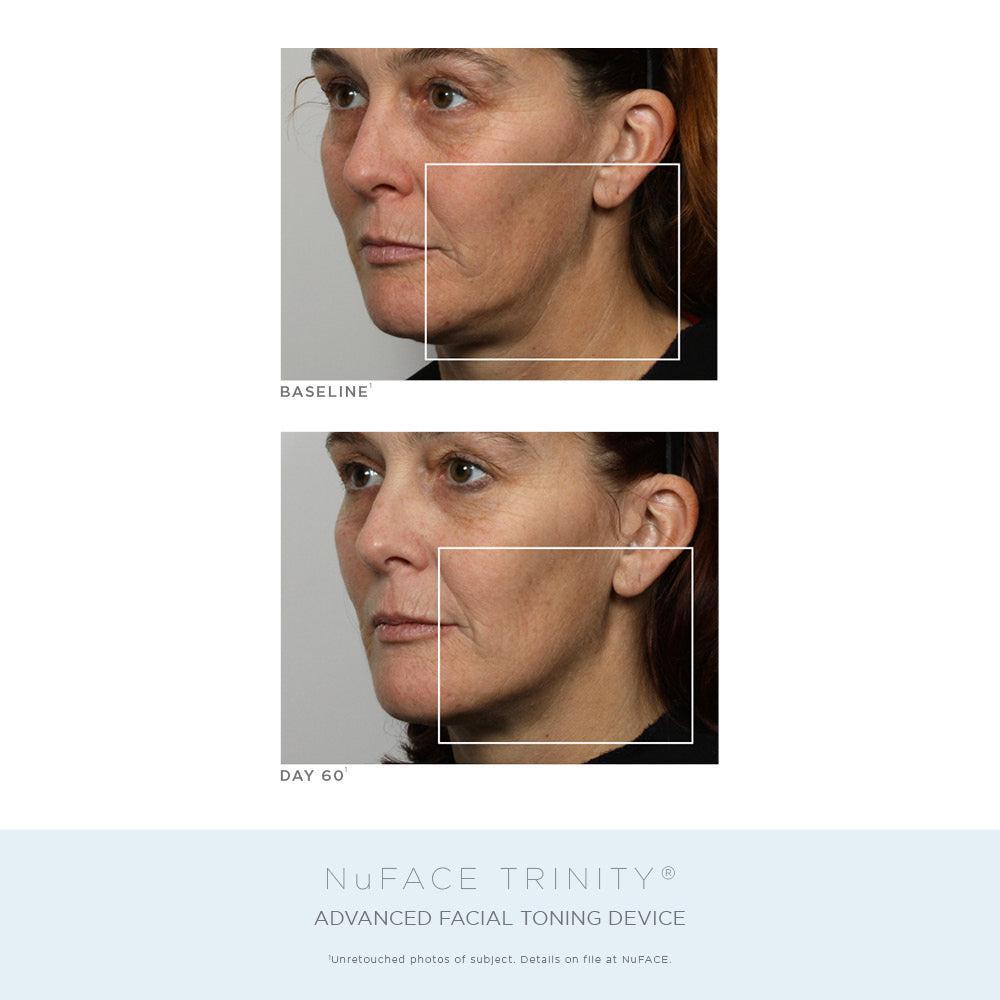 商品NuFace|NuFACE Trinity® Complete Facial Toning Kit ($623 VALUE),价格¥3865,第6张图片详细描述