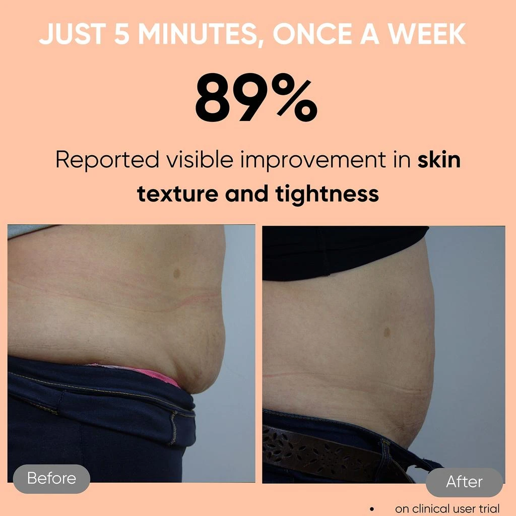 商品Sensica|Sensica Sensifirm RF for Cellulite,价格¥3324,第5张图片详细描述