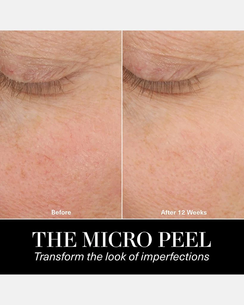 The Micro Peel Treatment, 1 oz. 商品