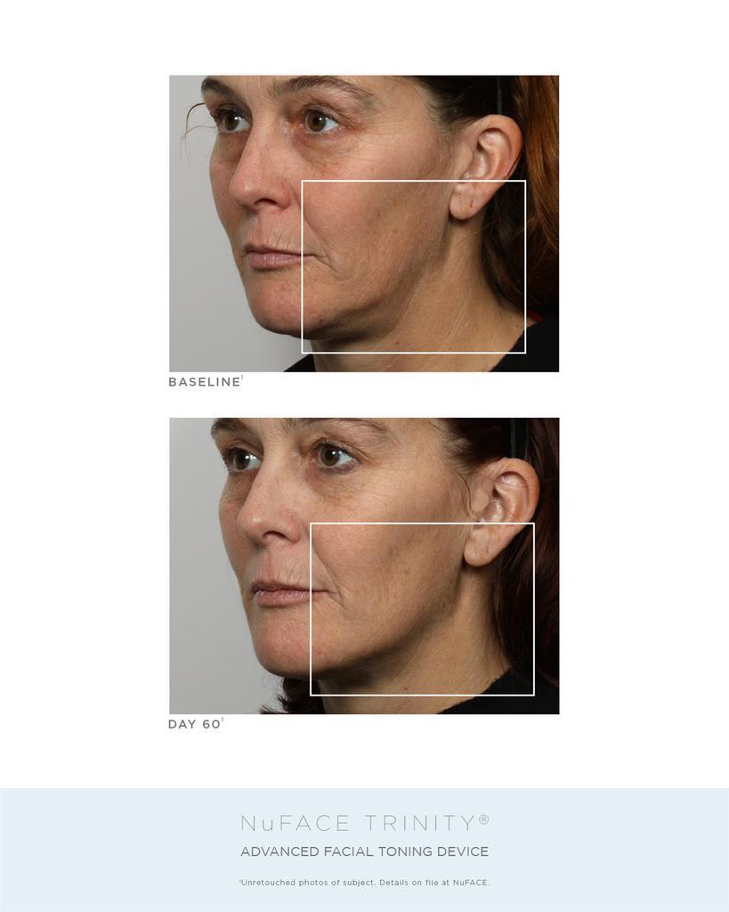 商品NuFace|Trinity® Complete Facial Toning Kit,价格¥3925,第5张图片详细描述