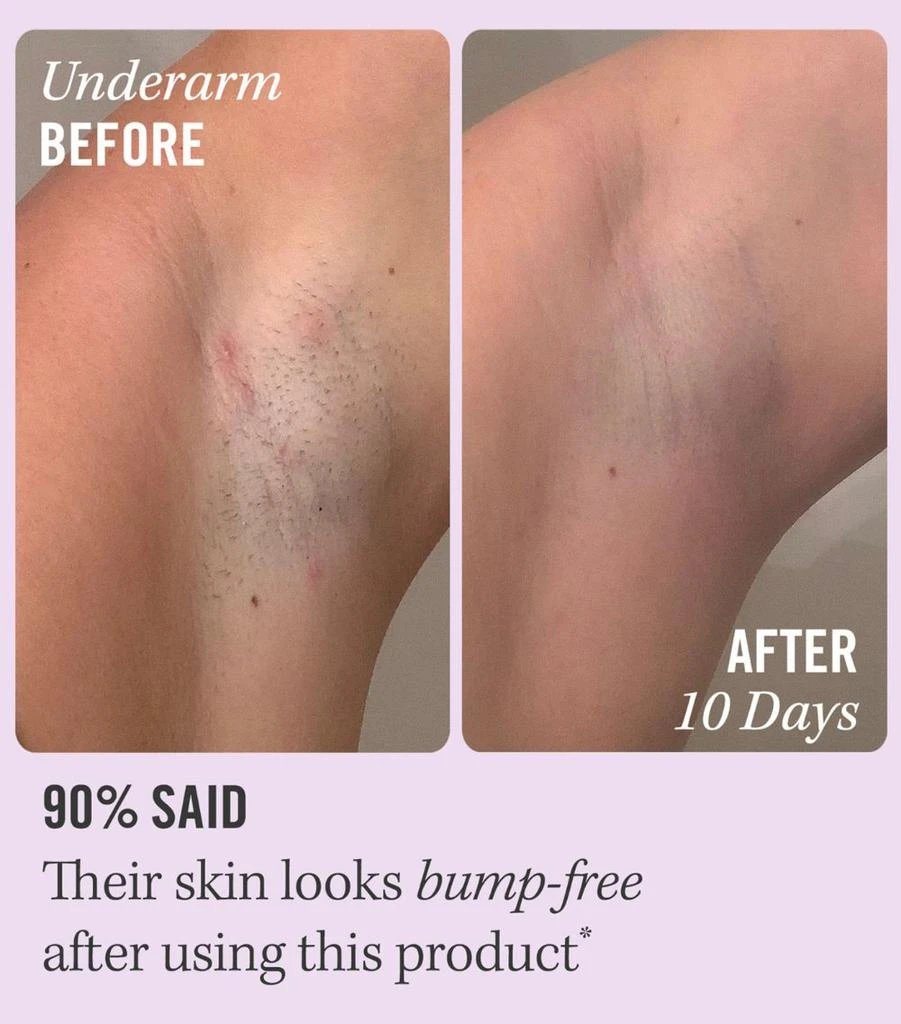 商品First Aid Beauty|Ingrown Hair Pads,价格¥343,第4张图片详细描述