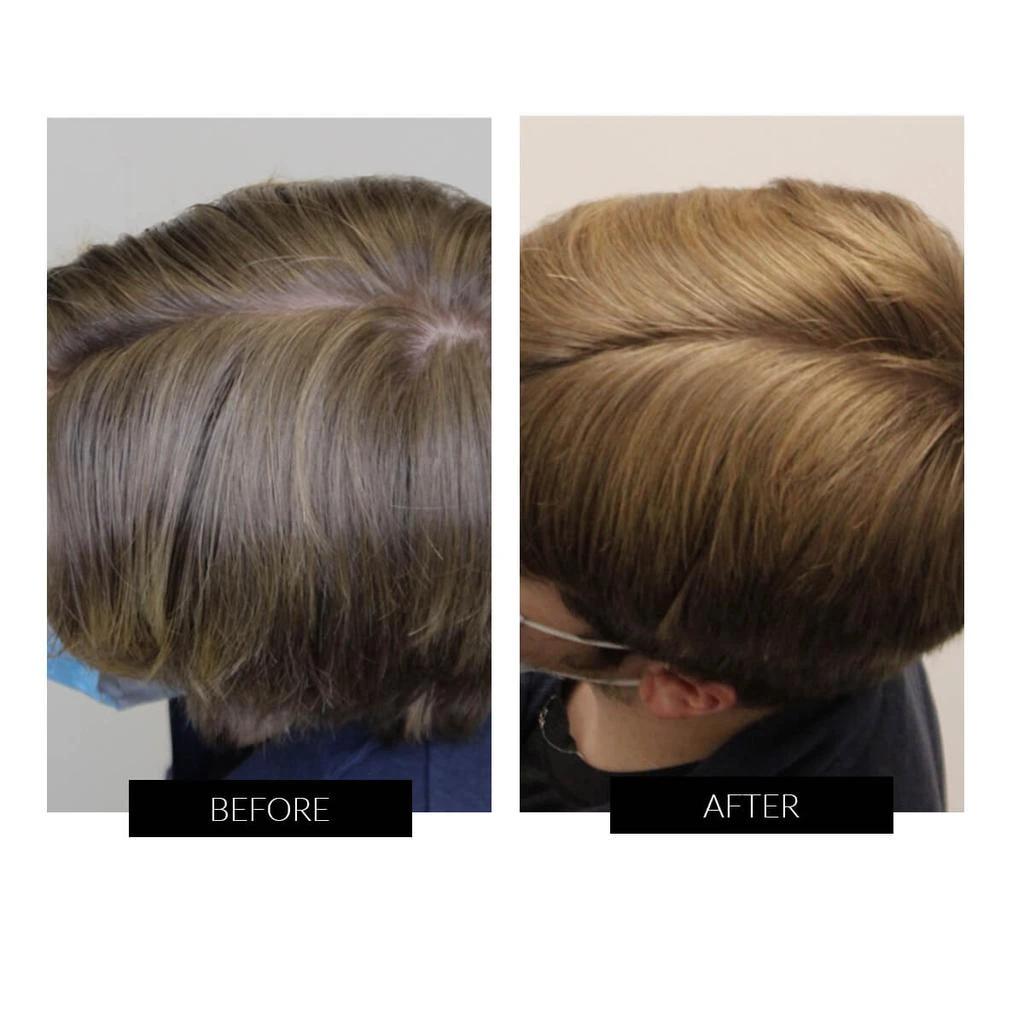 商品Capillus|CapillusOne Hair Regrowth Laser Cap,价格¥4751,第4张图片详细描述
