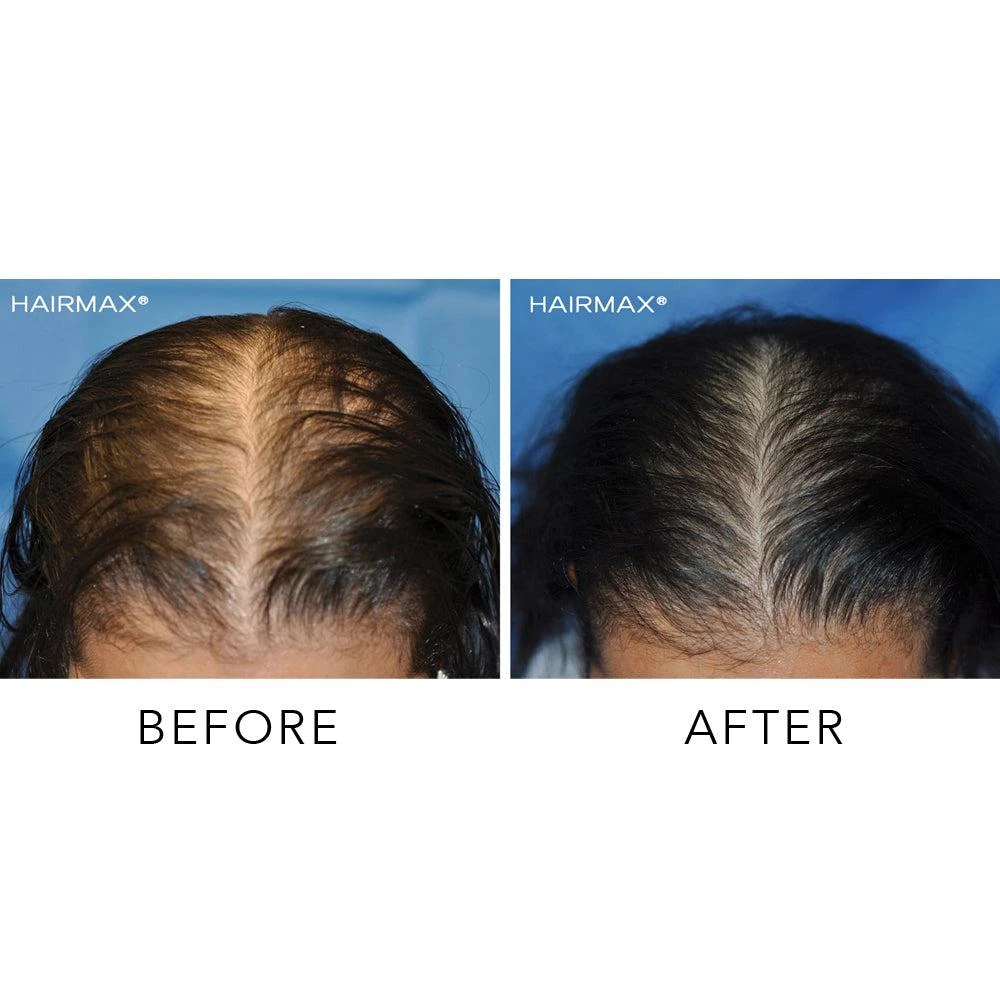 商品HairMax|9键光束激光生发梳子,价格¥1470,第5张图片详细描述