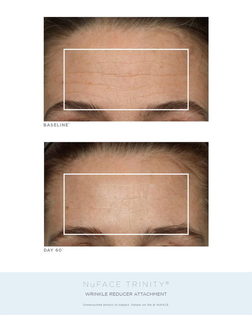 商品NuFace|Trinity® Complete Facial Toning Kit,价格¥3925,第6张图片详细描述