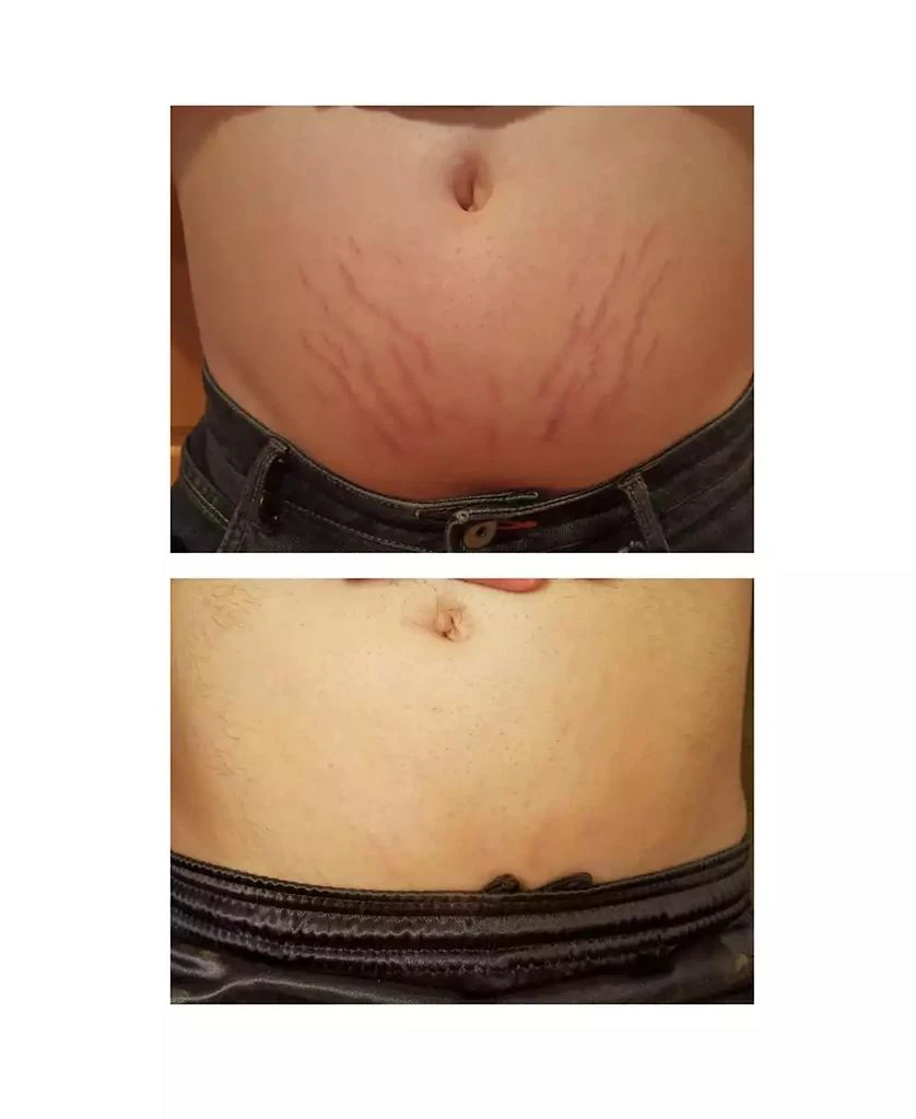 Stretchmark Device 商品