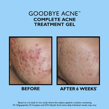 Peter Thomas Roth | Full-Size Goodbye Acne Acne Treatment Pair 2-Piece Acne Kit 独家减免邮费